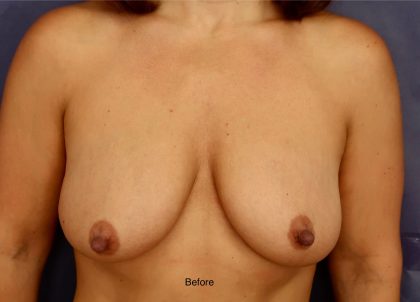 Breast Lift Before & After Patient #8739