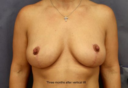 Breast Lift Before & After Patient #8739