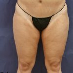 Liposuction Before & After Patient #8767