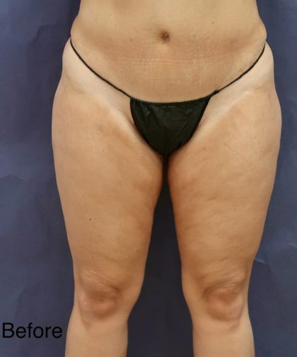 Liposuction Before & After Patient #8767