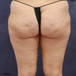 Liposuction Before & After Patient #8767