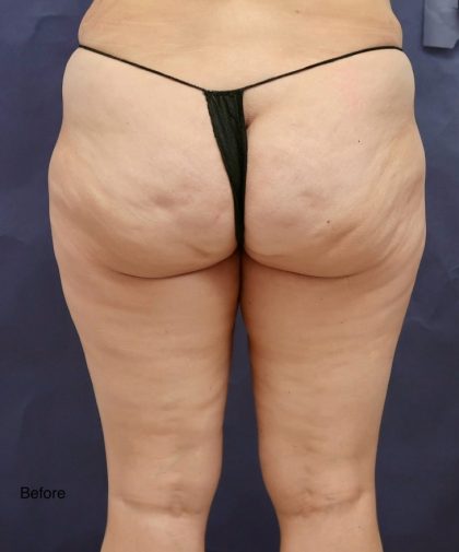 Liposuction Before & After Patient #8767