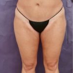 Liposuction Before & After Patient #8767