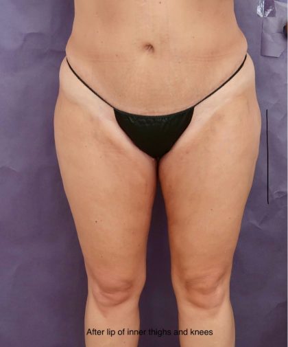 Liposuction Before & After Patient #8767