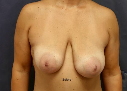 Breast Lift Before & After Patient #8772