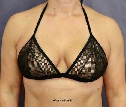 Breast Lift Before & After Patient #8772