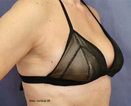 Breast Lift Before & After Patient #8772