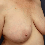 Breast Lift Before & After Patient #8791