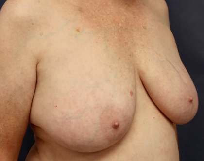 Breast Lift Before & After Patient #8791