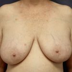 Breast Lift Before & After Patient #8791