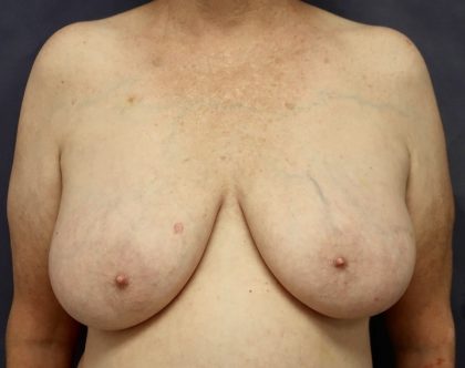 Breast Lift Before & After Patient #8791