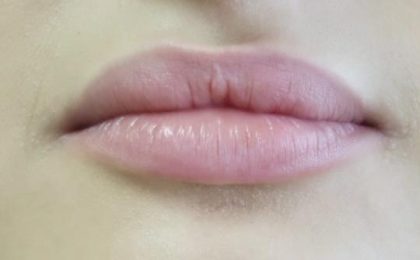 Lips Before & After Patient #8903