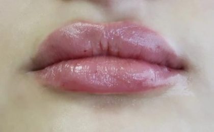 Lips Before & After Patient #8903