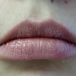 Lips Before & After Patient #8908