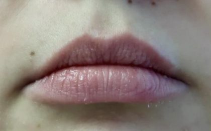 Lips Before & After Patient #8908