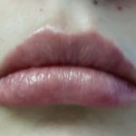 Lips Before & After Patient #8908