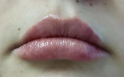 Lips Before & After Patient #8908